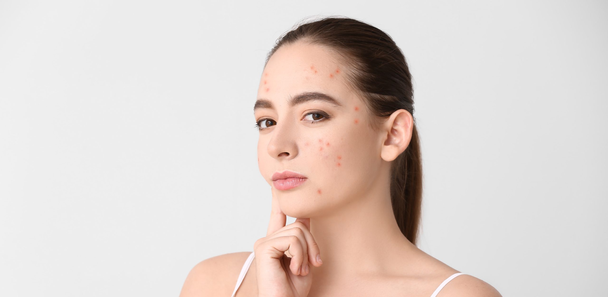 Acne Treatment In Dubai