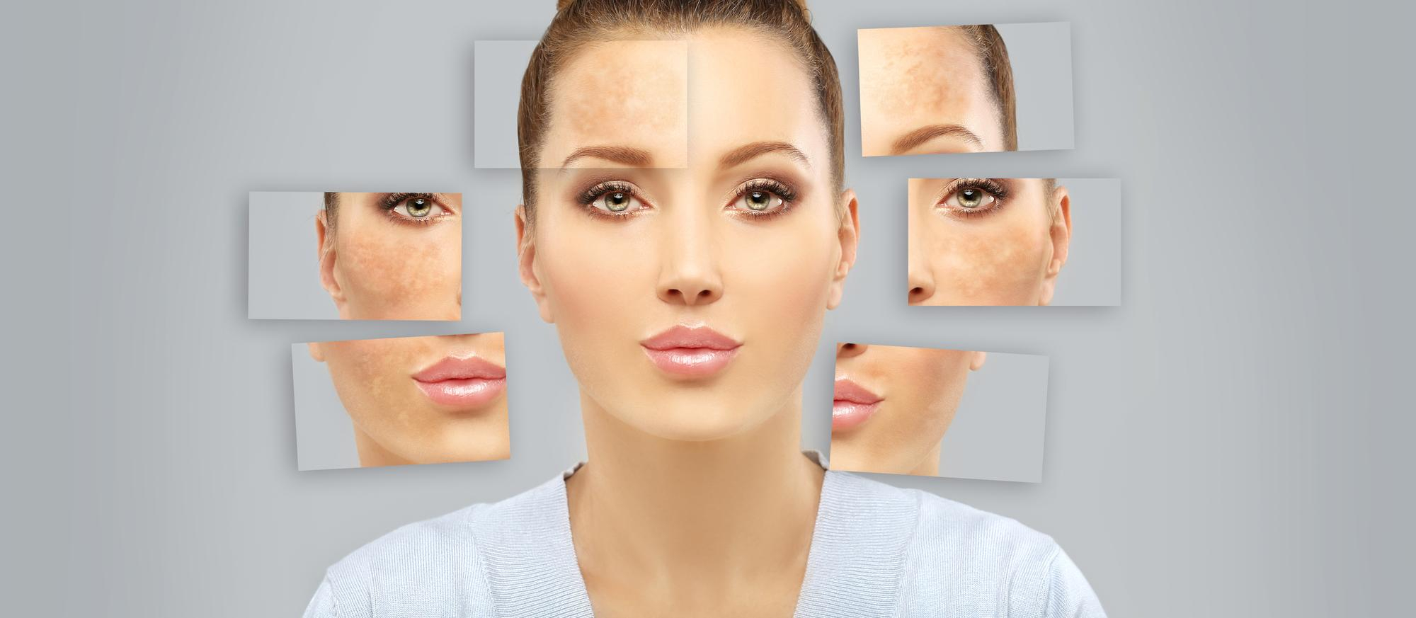 Pigmentation Treatment In Dubai