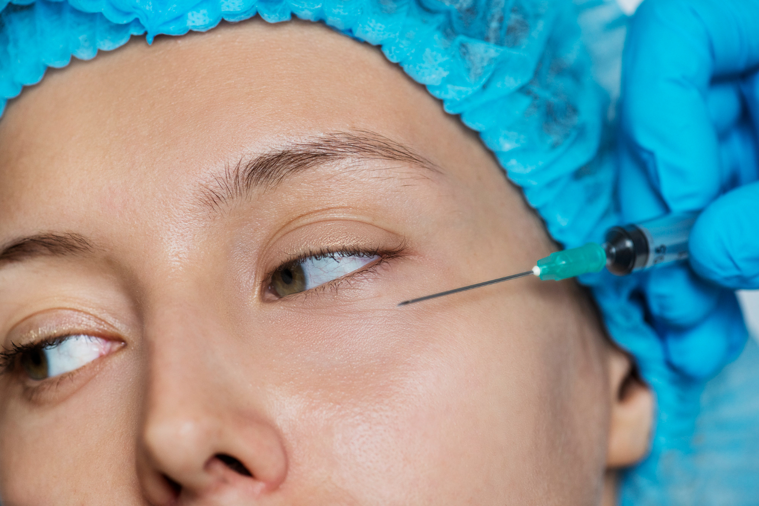 UNDER EYE FILLERS BEFORE AND AFTER